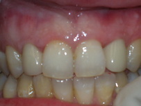 Harbor Dental Benicia teeth